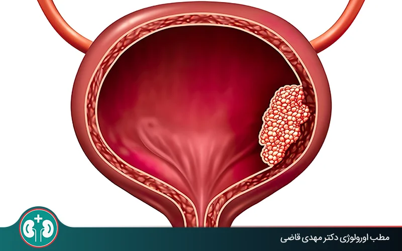 Can Bladder Cancer Be Cured? Recovery Chances Explained