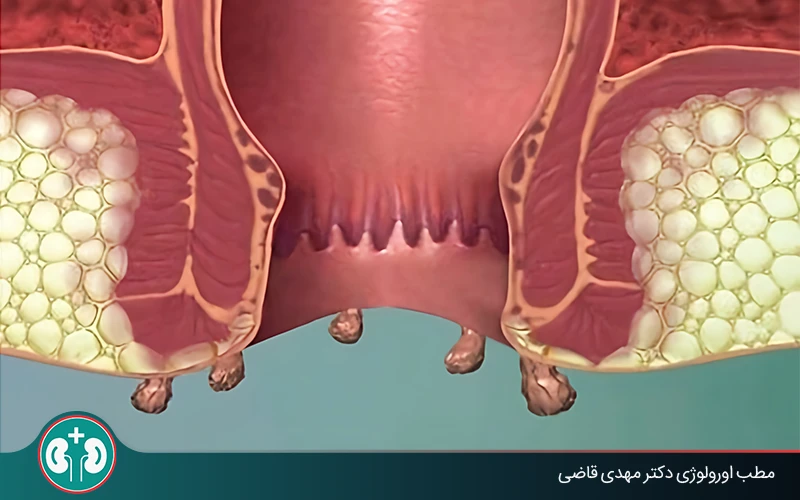 عوارض زگیل تناسلی مقعدی چیست؟ علائم هشدار + درمان
