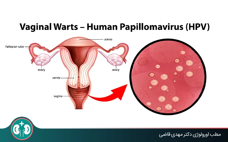 Complications of genital warts in women: recognition, prevention, and timely treatment
