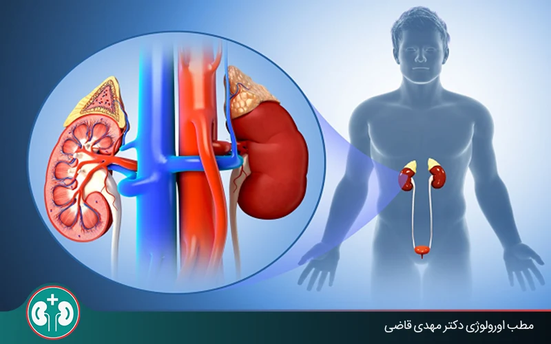 پیلونفریت چیست؟ علائم عفونت کلیه، تشخیص و درمان