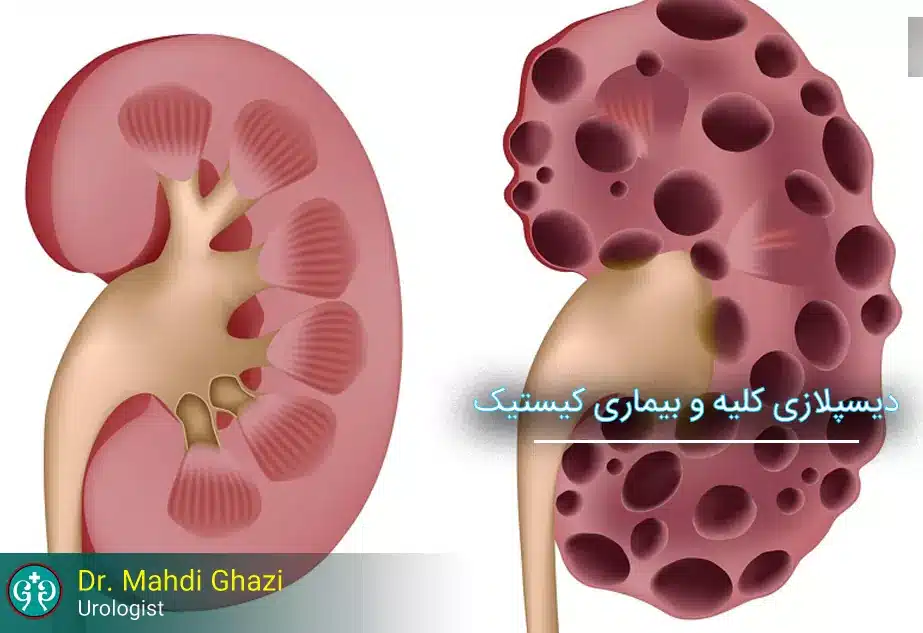 بیماری‌های کیستیک و دیسپلازی کلیه: علائم، تشخیص و درمان‌ های موثر