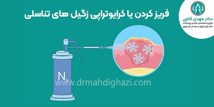 Freezing or Cryotherapy for genital warts