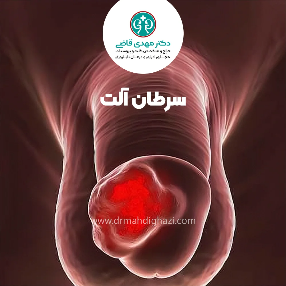 دکتر قاضی -سرطان آلت تناسلی درمان و علائم