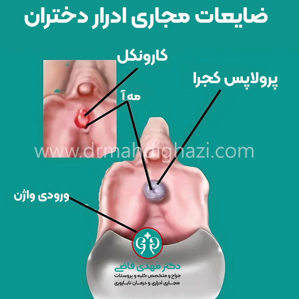 دکتر قاضی - • پیشگیری از عوارض توده‌های خوش خیم مجرای ادرار در دختران
