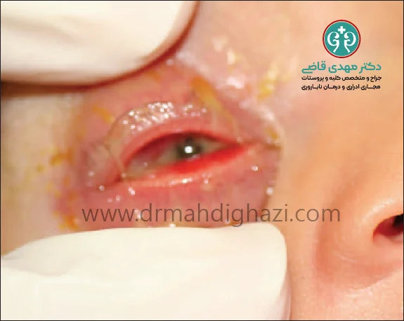 الدكتور مهدي قاضي-سوزاک: علائم، تشخیص، درمان و پیشگیری از این بیماری مقاربتی شایع