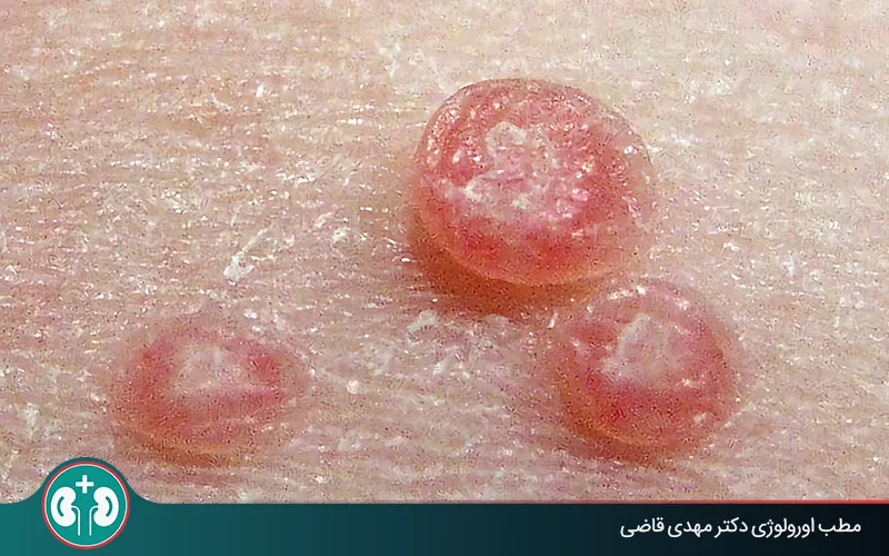 مولوسکوم بعد از چند مدت از بین میرود