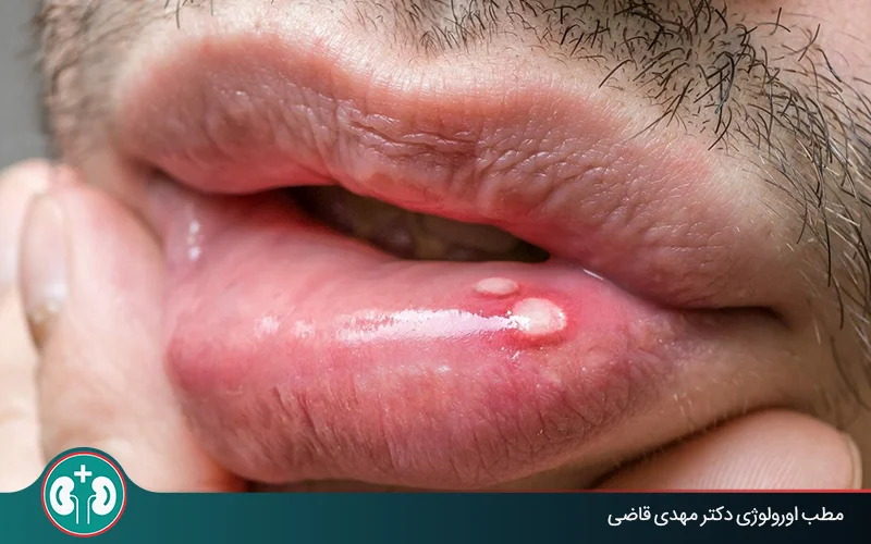 آیا تبخال دهان به ناحیۀ تناسلی منتقل میشود؟