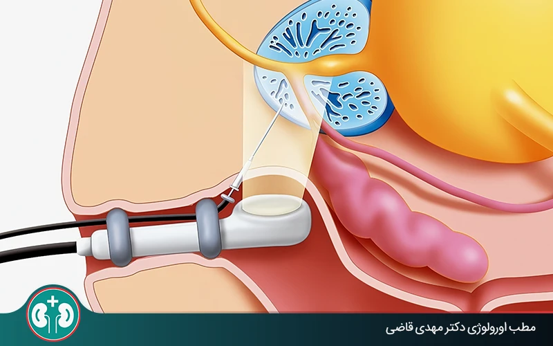 Risks and Side Effects of Prostate Biopsy: Complete Guide to Care After the Test