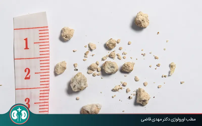 Passing 4 to 10 mm Kidney Stones: Symptoms, Passage, and Treatment