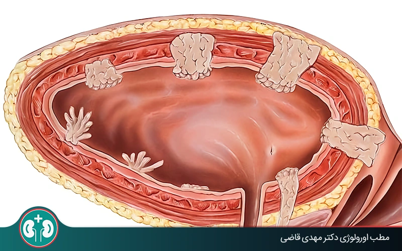 پولیپ مثانه چیست و چگونه درمان میشود؟