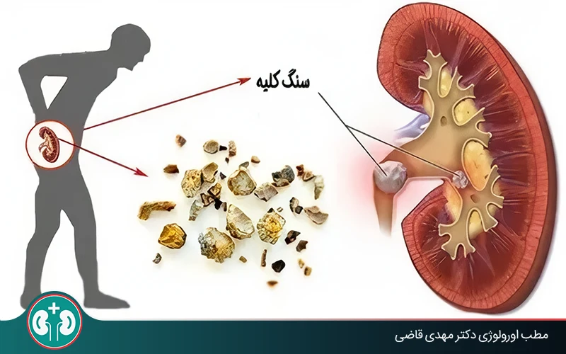اگر سنگ کلیه در مجاری ادراری باشد چه میشود؟