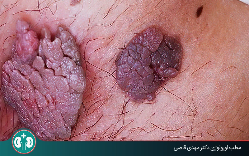 What Are the Symptoms of Low-Risk genital warts? Diagnosis and Treatment