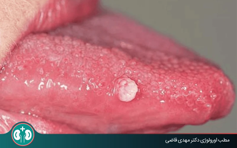 Signs of genital warts in the Mouth and How They Are Diagnosed and Treated