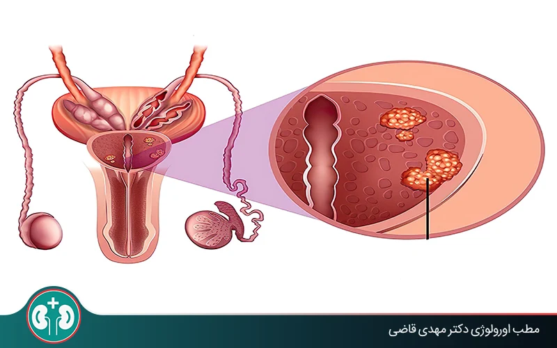 Complete Guide to Prostate Cancer Screening: Steps and Results