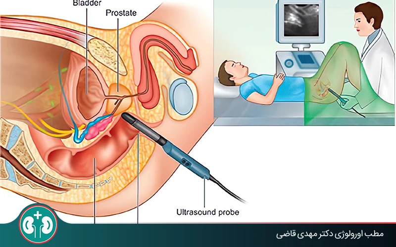 What Is Transrectal Prostate Ultrasound and Why Is It Done?