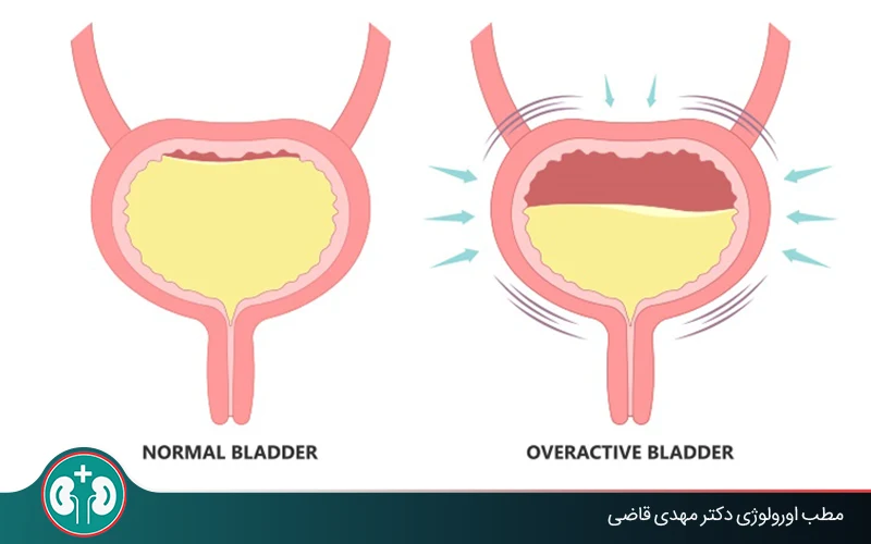 Herbal Remedies for Overactive Bladder: Scientific Review and Effective Medications