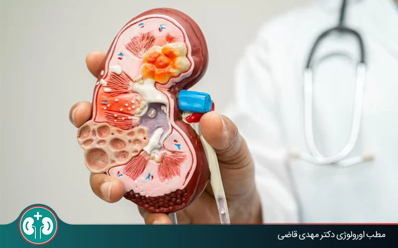 What Is Kidney Cancer? Is Kidney Cancer Fatal?