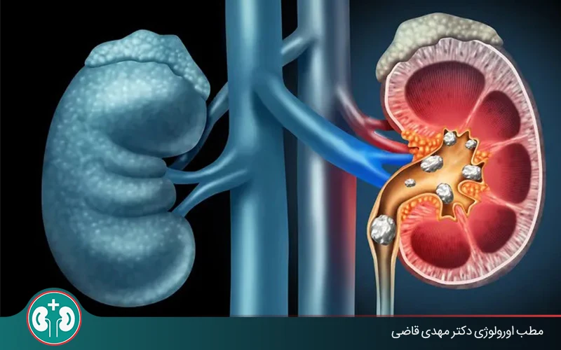 How Does a Ureteral Kidney Stone Pass?