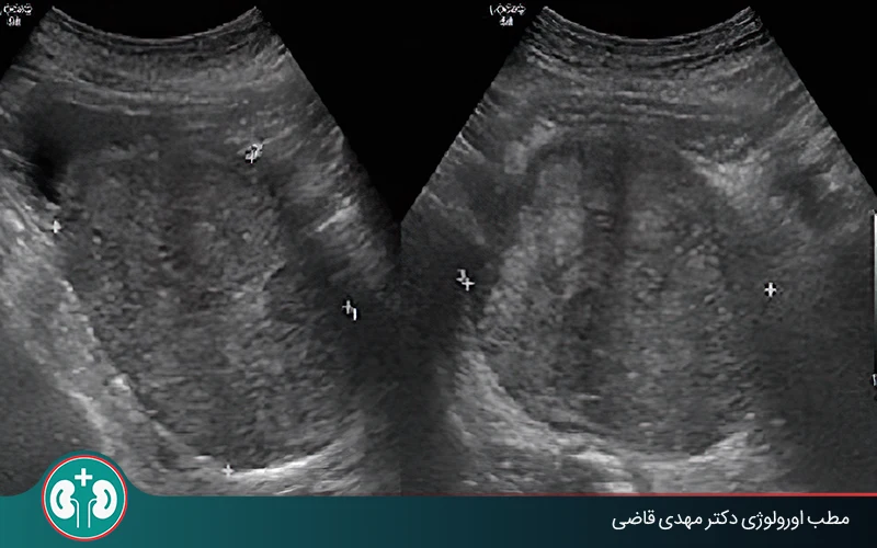 Prostate Ultrasound: Methods and Interpretation