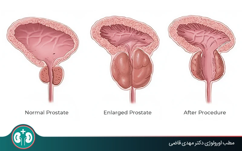 When Does the Prostate Need Surgery?