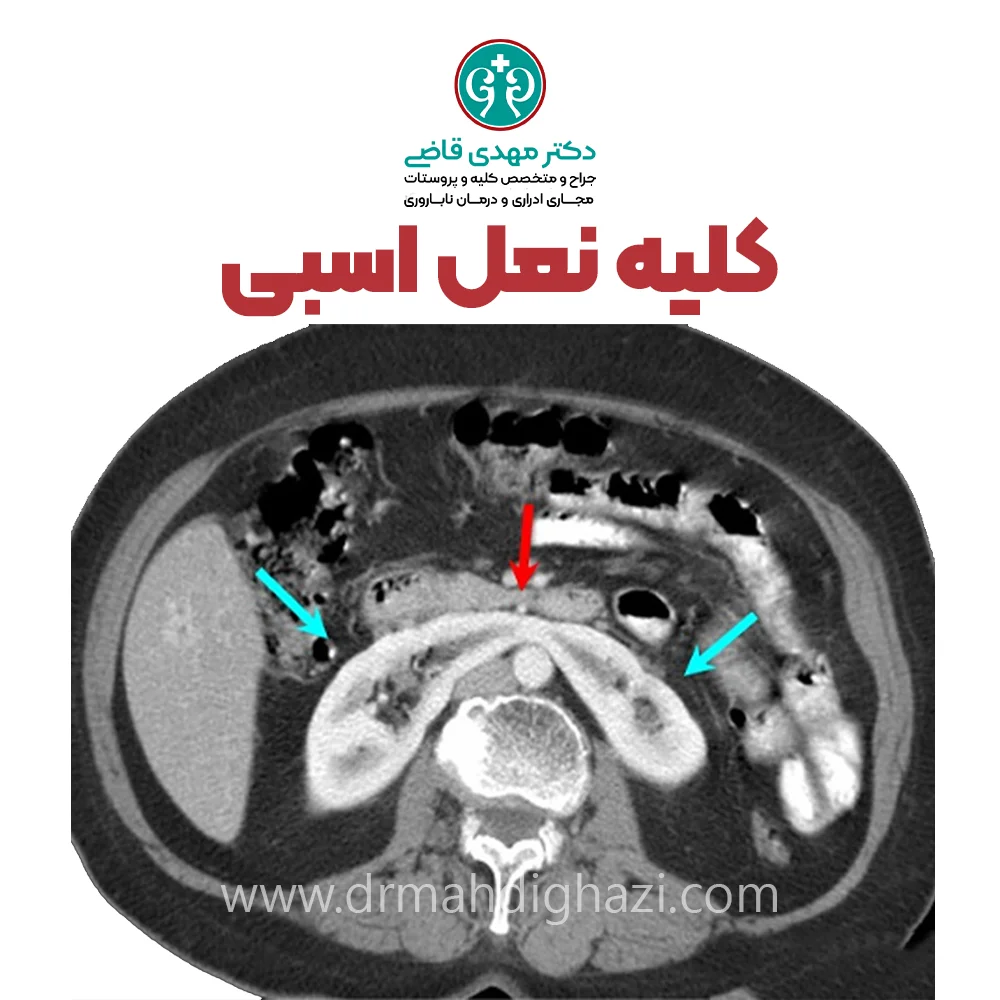 دکتر قاضی-کلیه نعل اسبی