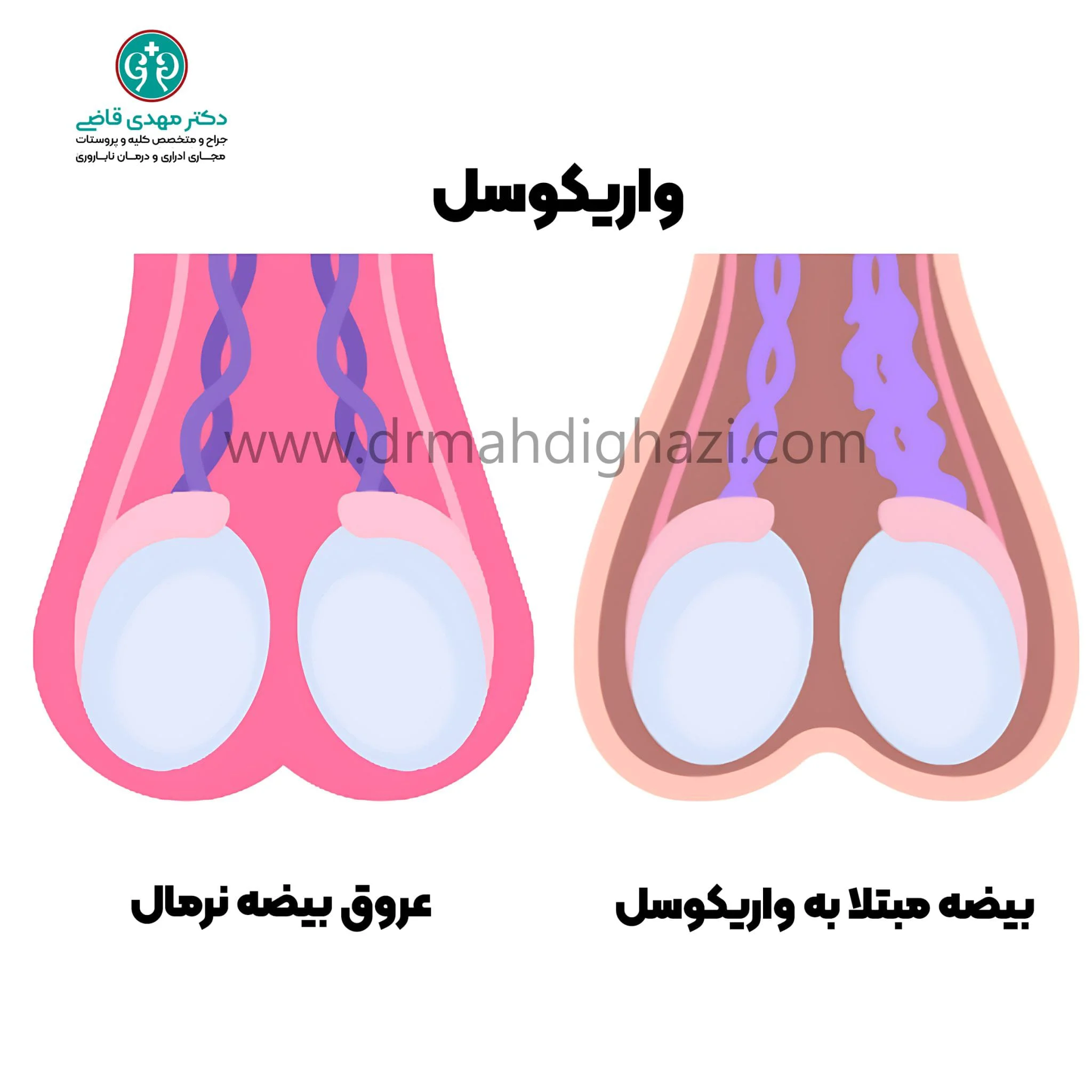 واریکوسل؛ علل، علائم، تأثیرات بر باروری و روشهای درمان