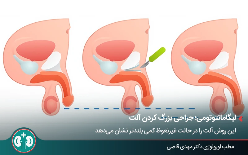 نحوه انجام جراحی قطع لیگامان از روشهای افزایش طول آلت تناسلی