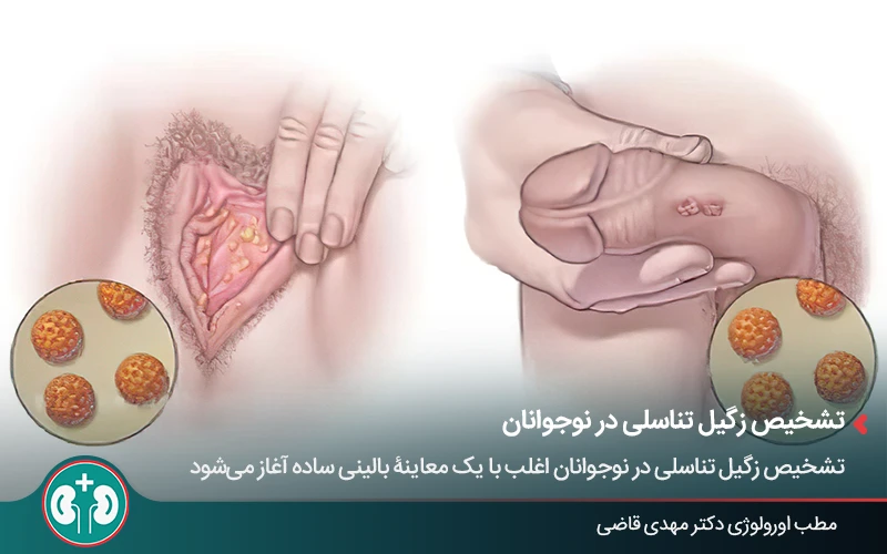 علائم زگیل تناسلی در نوجوانان و نشانههای ابتلا به HPV