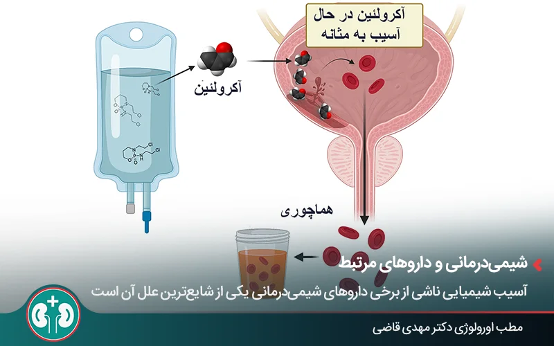 عکسی گرافیکی از داروی شیمیدرمانی، مثانۀ آسیبدیده و ادرار خونی - توضیح تصویری نحوۀ عملکرد آکرولئین درون مثانه