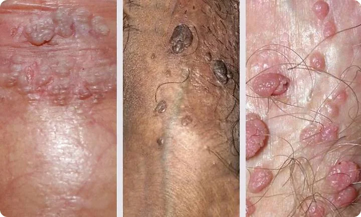 genital warts in men