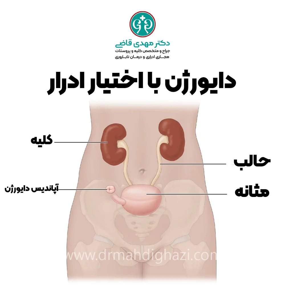 دکتر قاضی -مراقبتهای پس از جراحی دایورژن ادرار